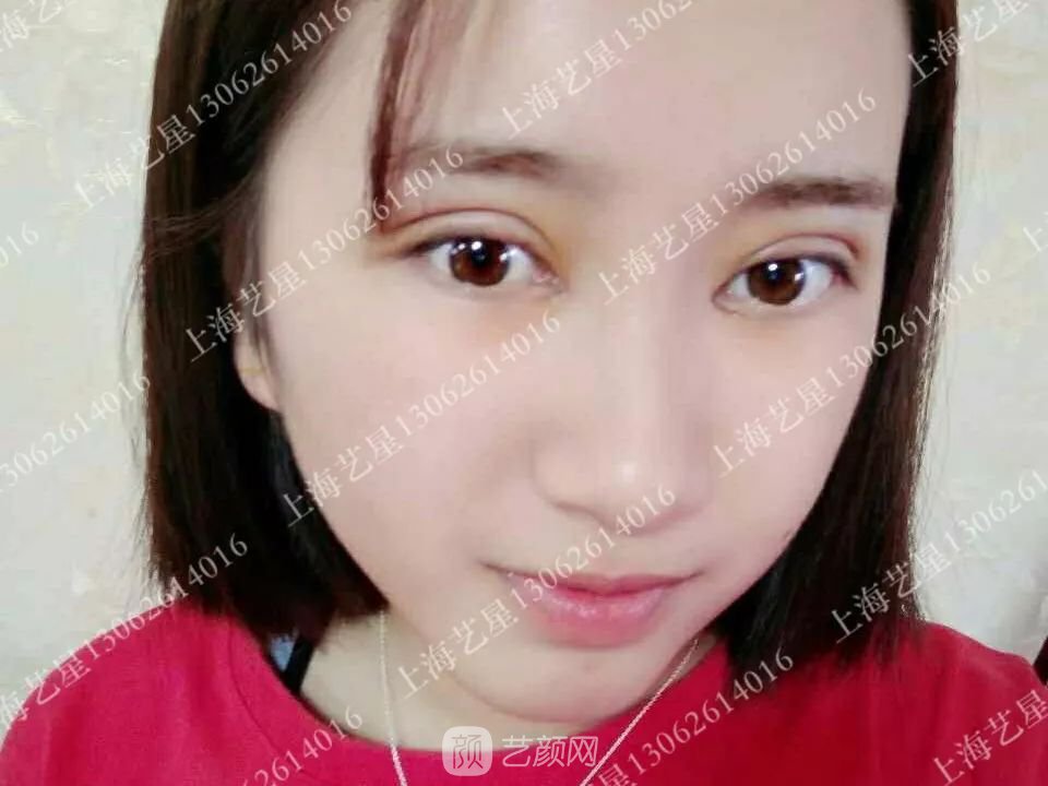 上海艺星割双眼皮术后一个月恢复日记一则~