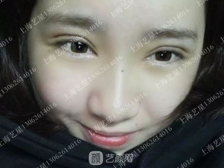 上海艺星割双眼皮术后一个月恢复日记一则~