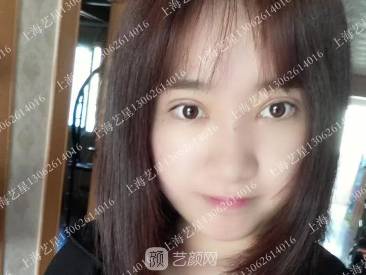 上海艺星割双眼皮术后一个月恢复日记一则~
