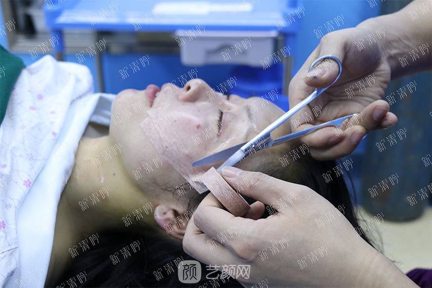 杭州新清吟陈永自体脂肪面部填充+注射瘦脸除皱案例直播~