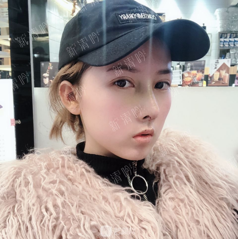 耳软骨综合隆鼻半个月了，分享恢复果照片~