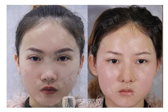 耳软骨综合隆鼻半个月了，分享恢复果照片~
