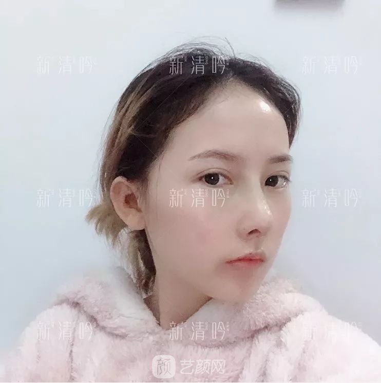 耳软骨隆鼻果怎么样？案例照片一览~
