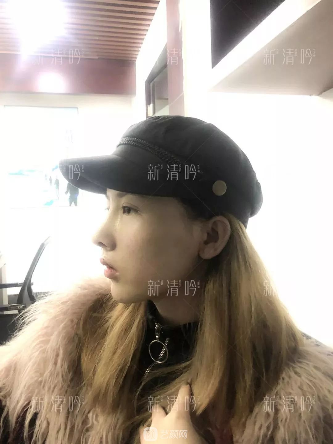 耳软骨隆鼻果怎么样？案例照片一览~