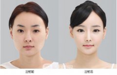 注射瘦脸注射瘦脸多少钱
