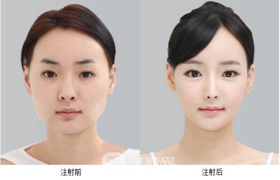 注射瘦脸注射瘦脸多少钱