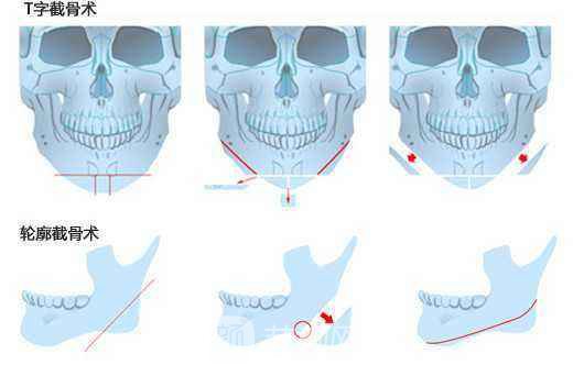 【北京磨腮骨大概多少钱?】