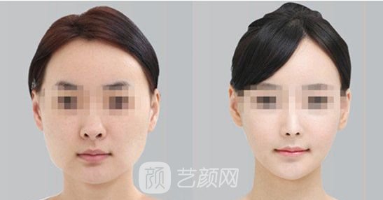 【北京磨腮骨大概多少钱?】