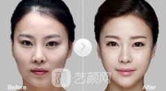 北京磨骨大概多少钱?