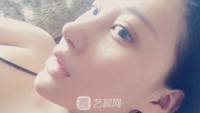 王著之心激光祛斑果好吗?