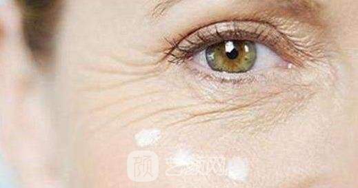 去鱼尾纹一般要多少钱?