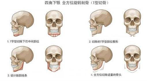 下颌角截骨手术注意事项有哪些?