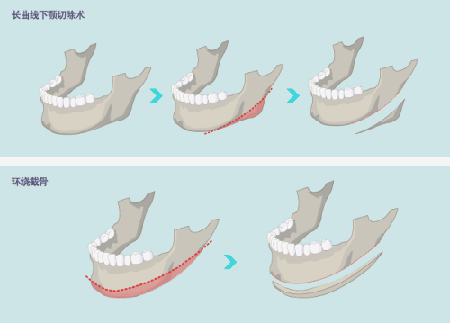 下颌角截骨手术注意事项有哪些?