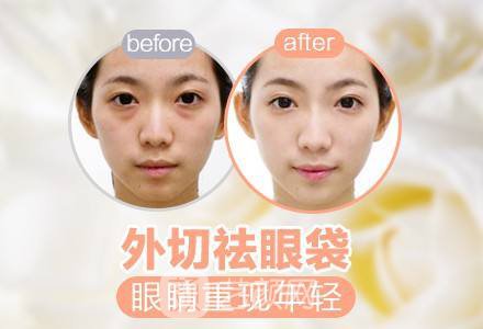 外切去眼袋果好吗?外切去眼袋果图~