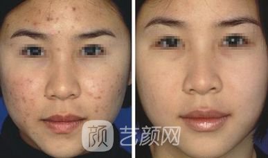 像素激光祛痘大概多少钱?