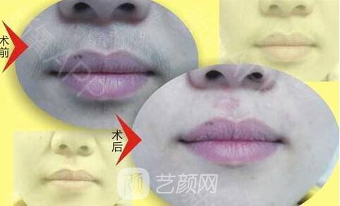 莱西尔脱毛是什么?莱西尔脱毛有什么优势?