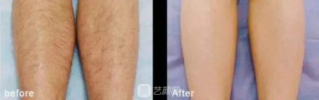 莱西尔脱毛是什么?莱西尔脱毛有什么优势?