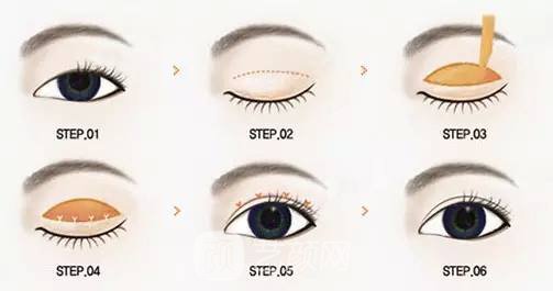 不开刀怎么做双眼皮?不开刀做双眼皮靠谱吗?