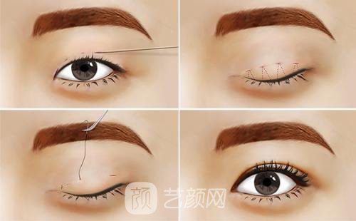 不开刀怎么做双眼皮?不开刀做双眼皮靠谱吗?