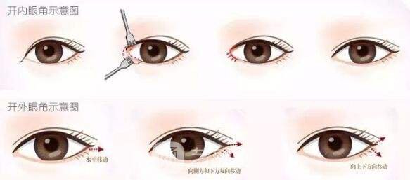 不开刀怎么做双眼皮?不开刀做双眼皮靠谱吗?