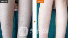 南宁激光脱毛大概多少钱