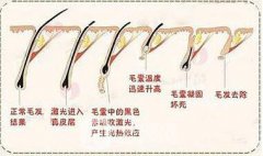 贵阳激光脱毛一般要多少钱