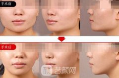 磨下颌骨需要多少钱呢