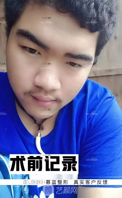 眼部手术案例——昆明募蓝术后一年果照片分享~