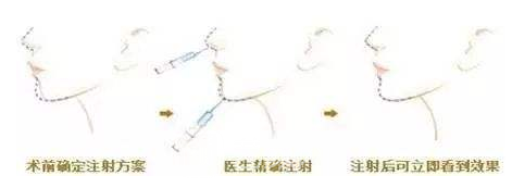 艺颜网玻尿酸注射的费用一览表