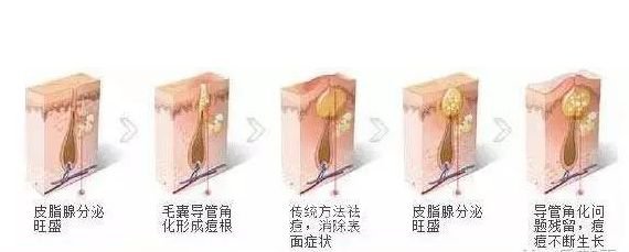 像素激光去痘印果好吗？