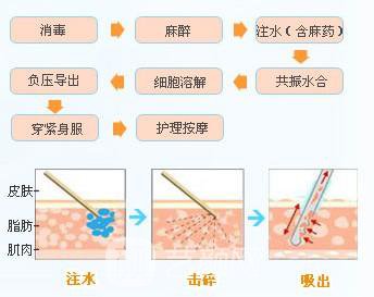 360度环形吸脂会反弹吗?