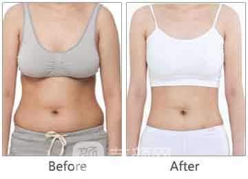 360度环形吸脂会反弹吗?