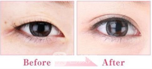 开眼角有危险吗?没问题吗?