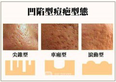 怎么调节痘疤比较好?调节痘疤有哪些方法?