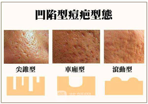 怎么调节痘疤比较好?调节痘疤有哪些方法?