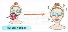 去颊脂垫和吸脂哪个好?