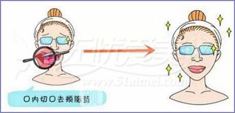 去颊脂垫和吸脂哪个好?