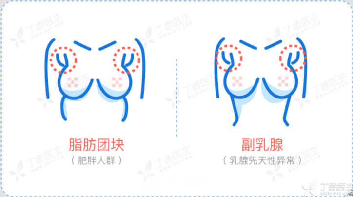 副乳吸脂后会反弹吗