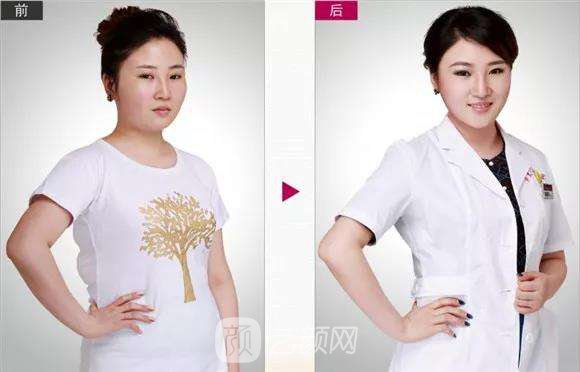 副乳吸脂后会反弹吗