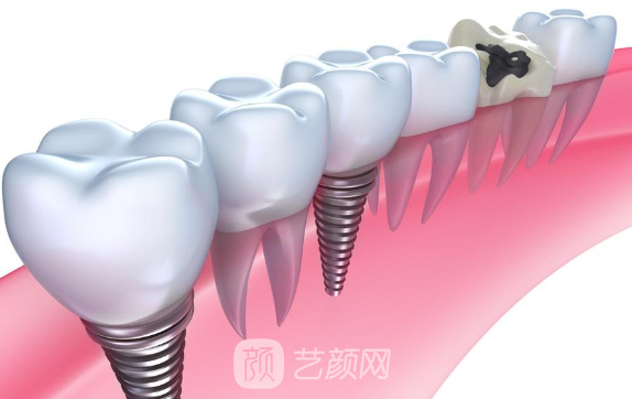 做假牙好还是种植牙好