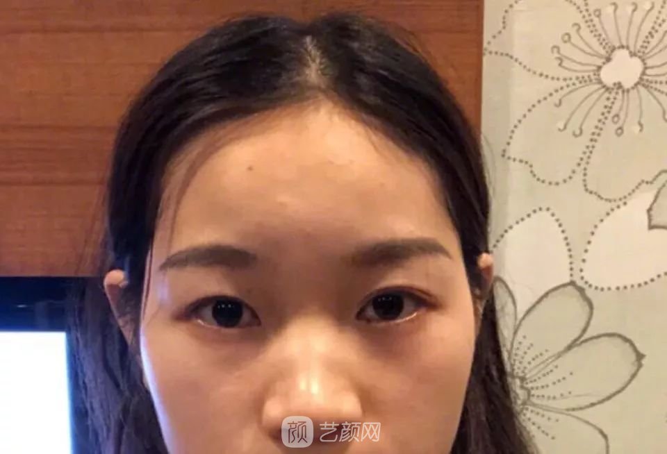 鼻部手术一个月恢复日记分享~