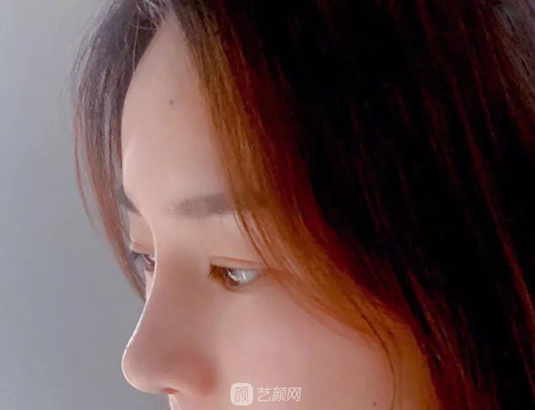 鼻部手术一个月恢复日记分享~