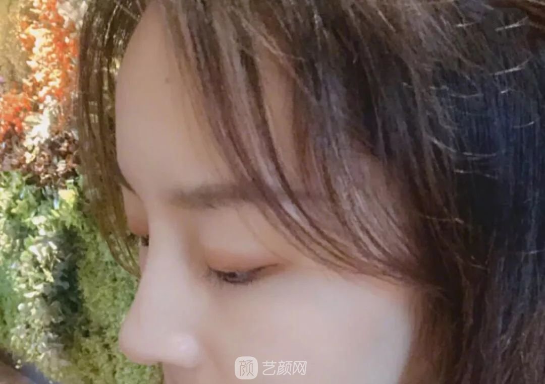 鼻部手术一个月恢复日记分享~