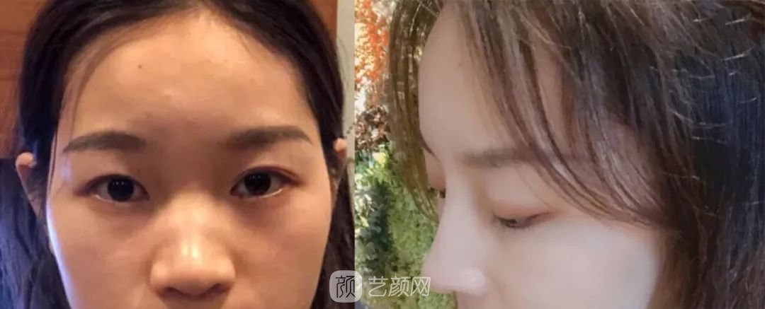 鼻部手术一个月恢复日记分享~
