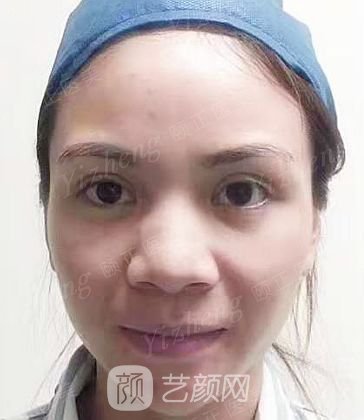 葫芦岛颐正夏秉成鼻部手术+SVF自体脂肪多方面部填充案例~