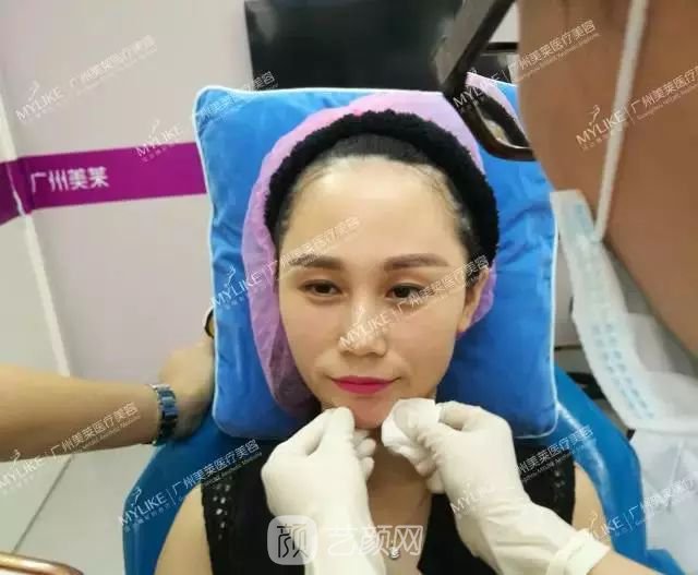 广州美莱玻尿酸全脸填充果照片分享~