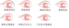 割双眼皮修复要多少钱
