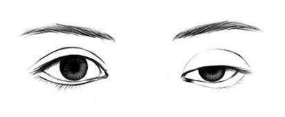 割双眼皮修复要多少钱