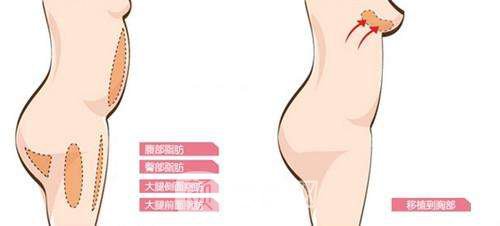 假体隆胸后感觉怎样