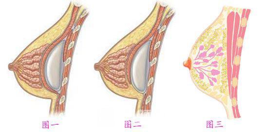 假体隆胸后感觉怎样